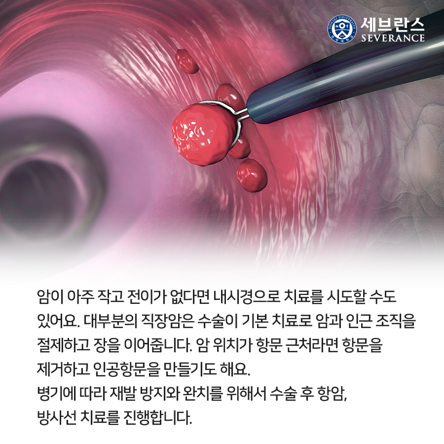 암이 아주 작고 전이가 없다면 내시경으로 치료를 시도할 수도 있어요. 대부분의 직장암은 수술이 기본 치료로 암과 인근 조직을 절제하고 장을 이어줍니다. 암 위치가 항문 근처라면 항문을 제거하고 인공항문을 만들기도 해요. 병기에 따라 재발 방지와 완치를 위해서 수술 후 항암, 방사선 치료를 진행합니다. 